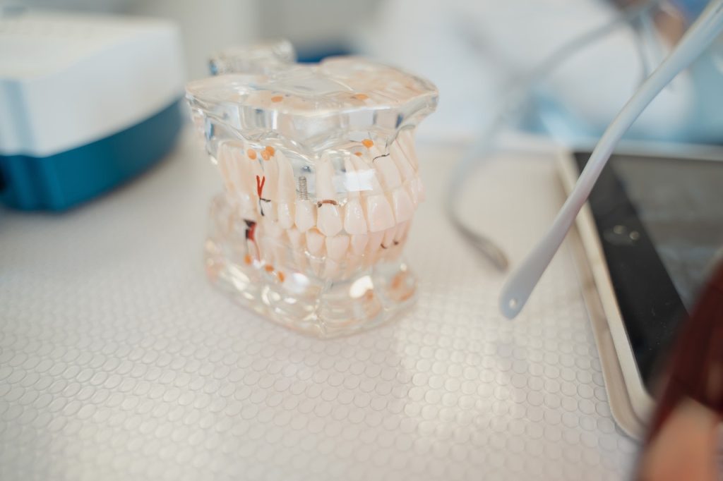 6 Things to Know About Dentures Dentures